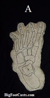 1969 Bigfoot Cripple Foot cast A